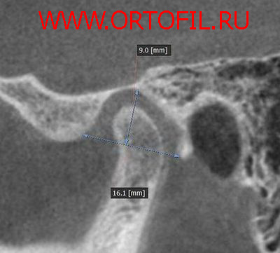 Зонограмма ВНЧС