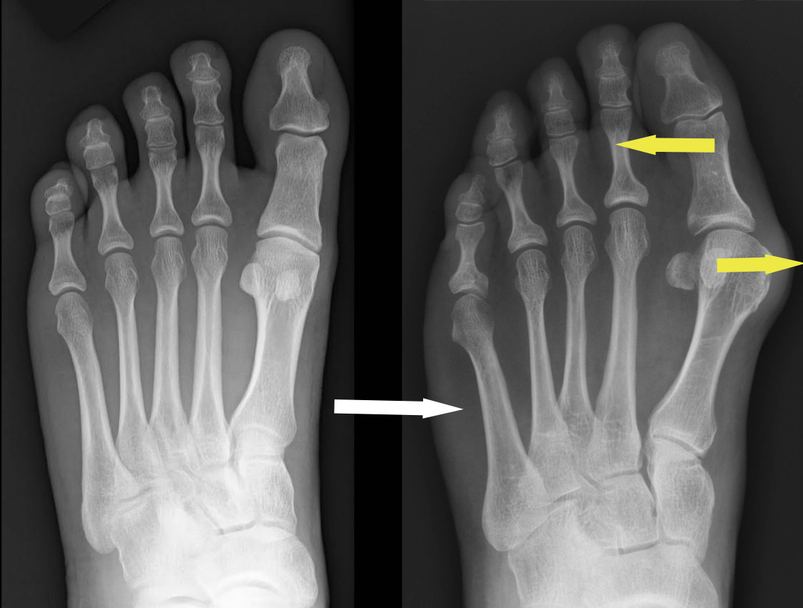 Пример рентгенограмм стопы без деформации (слева) и с характерным смещением костей (справа). Обратите внимание на "кругляшки" в области сустава. Это сесамовидные кости - важный элемент работы сустава и ориентир во время операций.