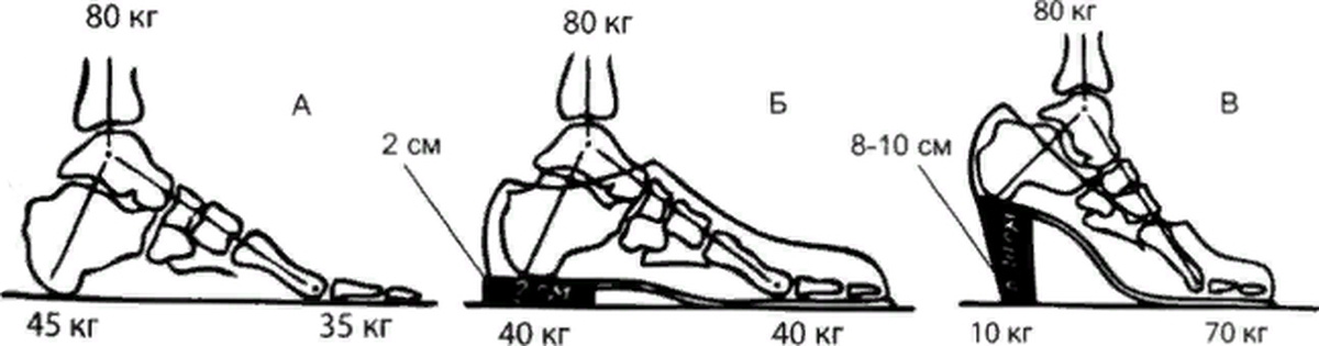 Обувь на высоких каблуках влияет на распределение нагрузки на разные отделы стопы и может служить предрасполагающим фактором развития деформаций.