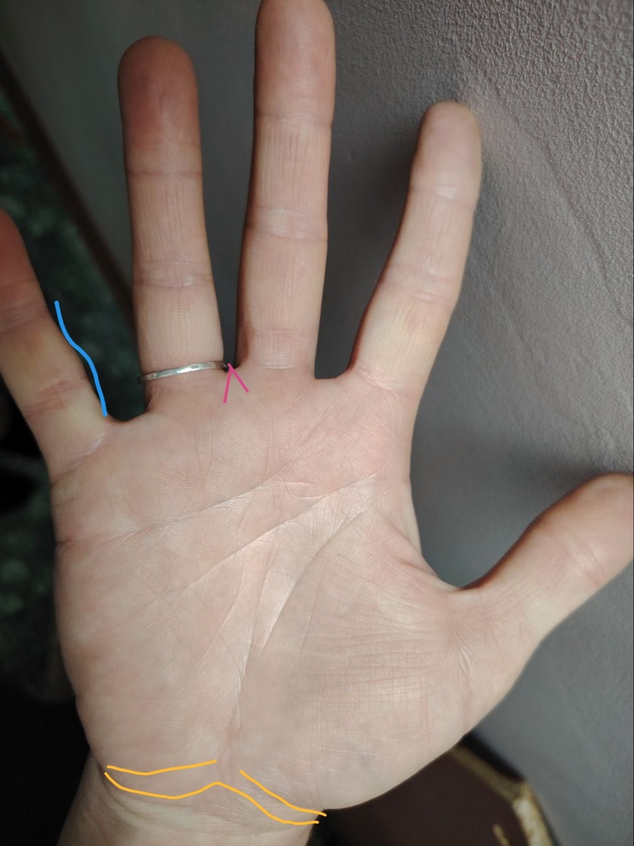 Два варианта дефектных браслетов, шинекологических мизинец и вилка. 