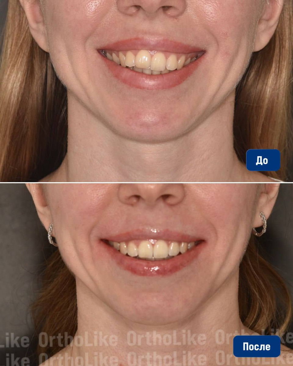 Исправление скученности зубов и асимметрии на элайнерах: до и после лечения