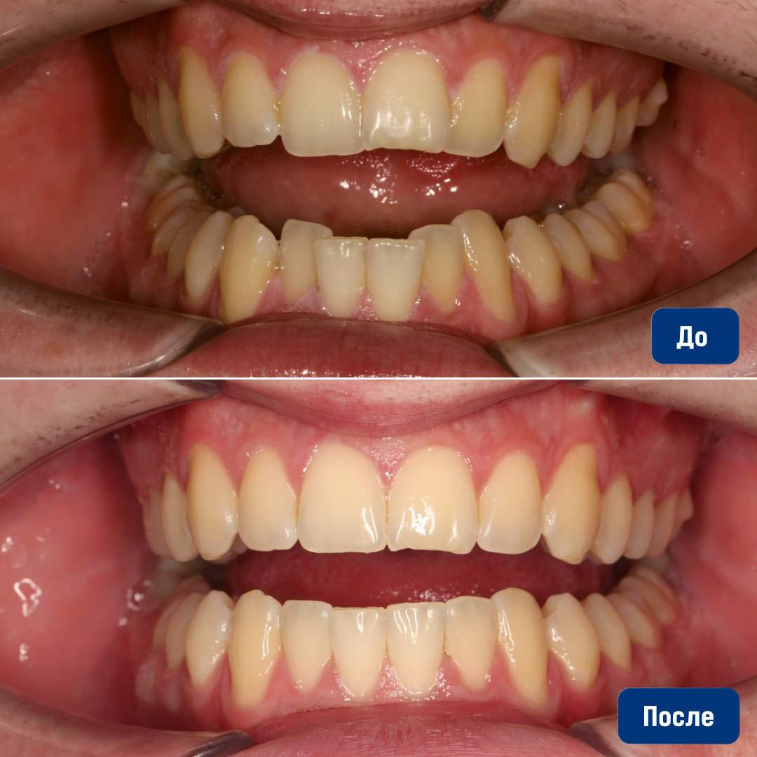 Лечение на элайнерах: до и после