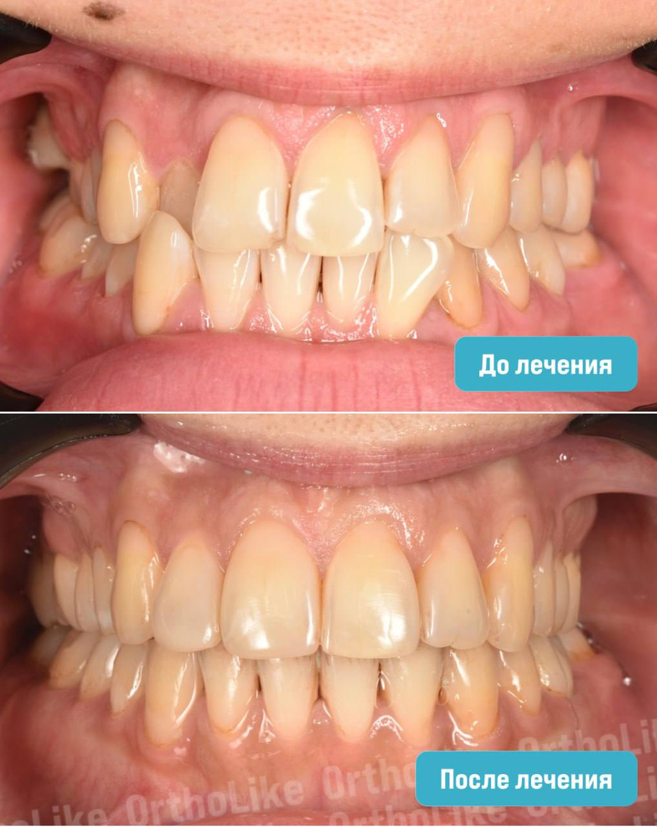 Исправление мезиального прикуса: до и после лечения