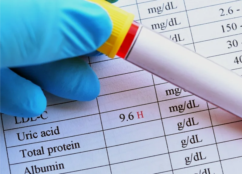 Повышенный уровень билирубина: причины, симптомы и лечение