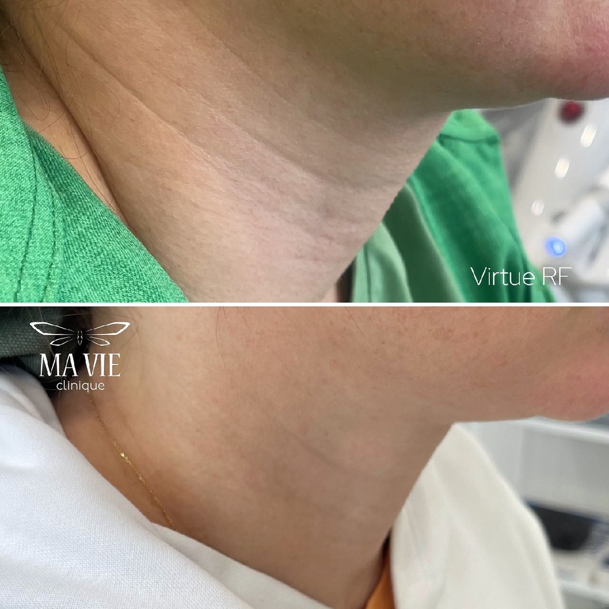 До и после Virtue RF