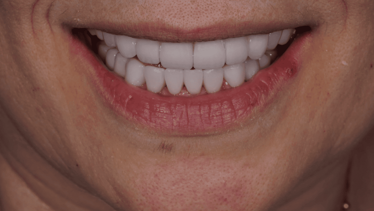 Протезирование зубов на имплантах