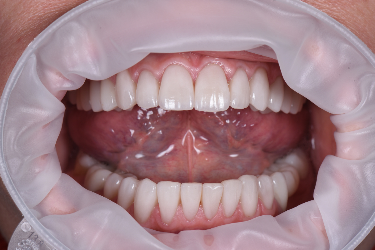 У пациентки полное протезирование керамическими реставрациями