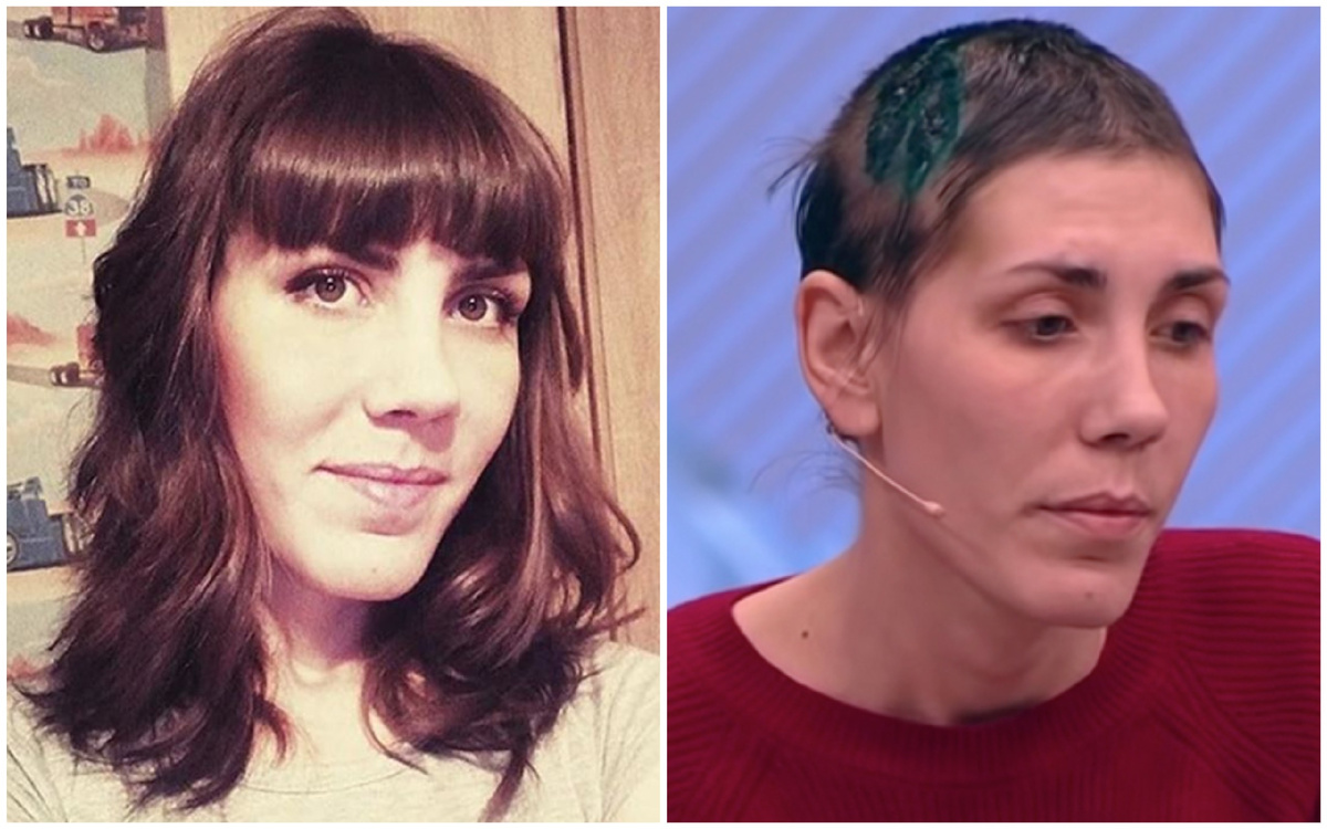 Фото до произошедшего: опубликовано «КП» из архива героини. Фото после: стоп-кадр передачи «Пусть говорят»