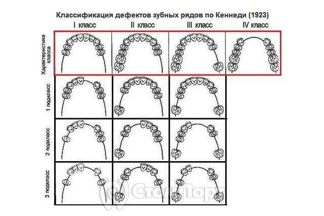 Классификация деффектовзубных рядов по Кеннеди