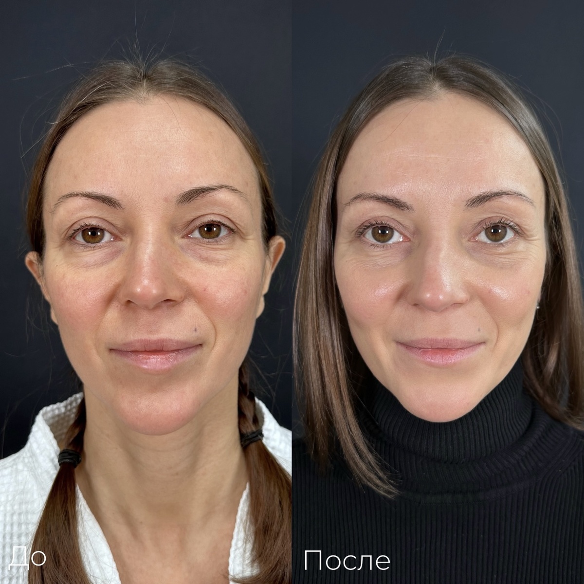 Блефаропластика. Пластический хирург Рами Хамуд. 