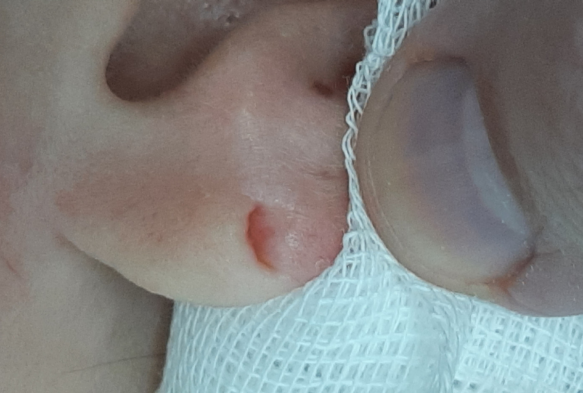 Та же ушная раковина, что и на первом фото. Виден сквозной эпителизированный (заживший) дефект мочки ушной раковины. При некотором оттягивании становятся видны внутренние своды дефекта. Фото из архива автора.