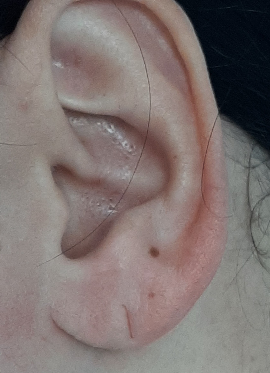 Сквозной, давний дефект мочки ушной раковины после травматизации серьгой. Фото из архива автора.