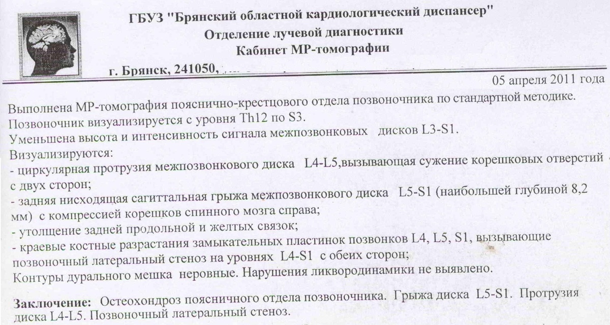 межпозвоночная грыжа 8,2 мм, последствие падения с высоты