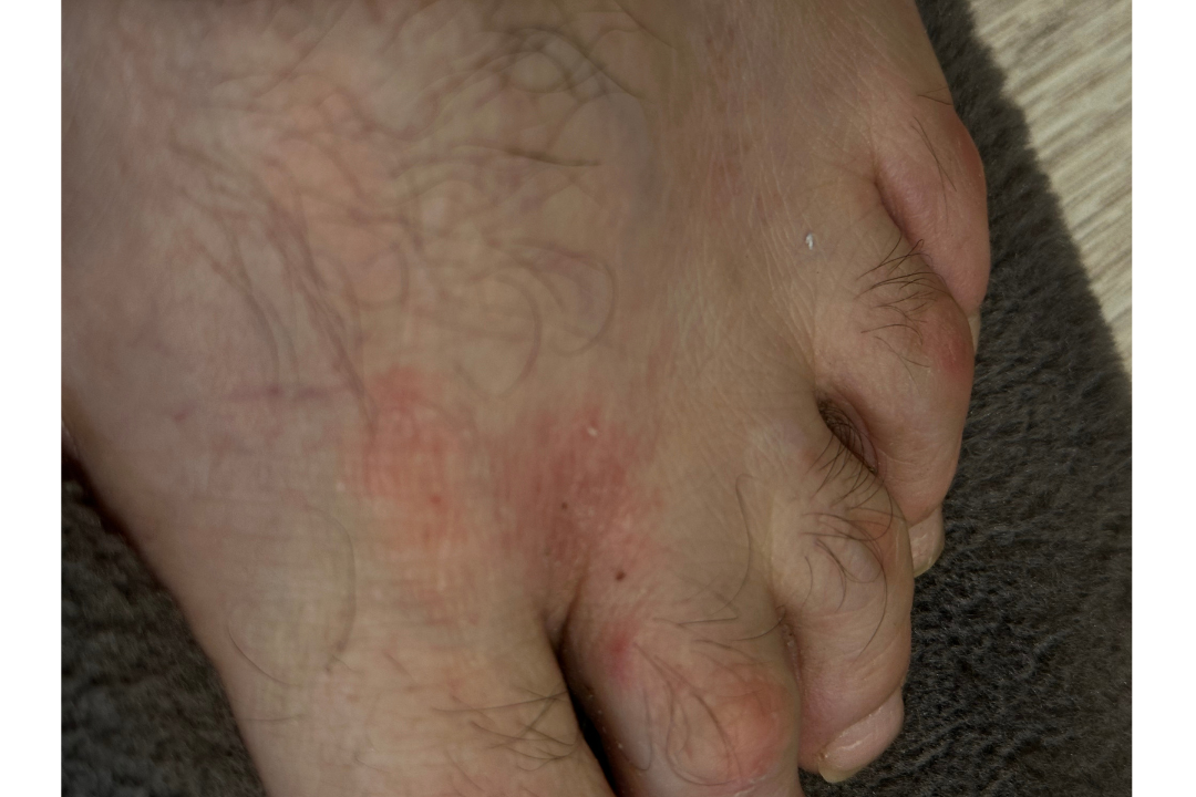 Экзема на ногах 