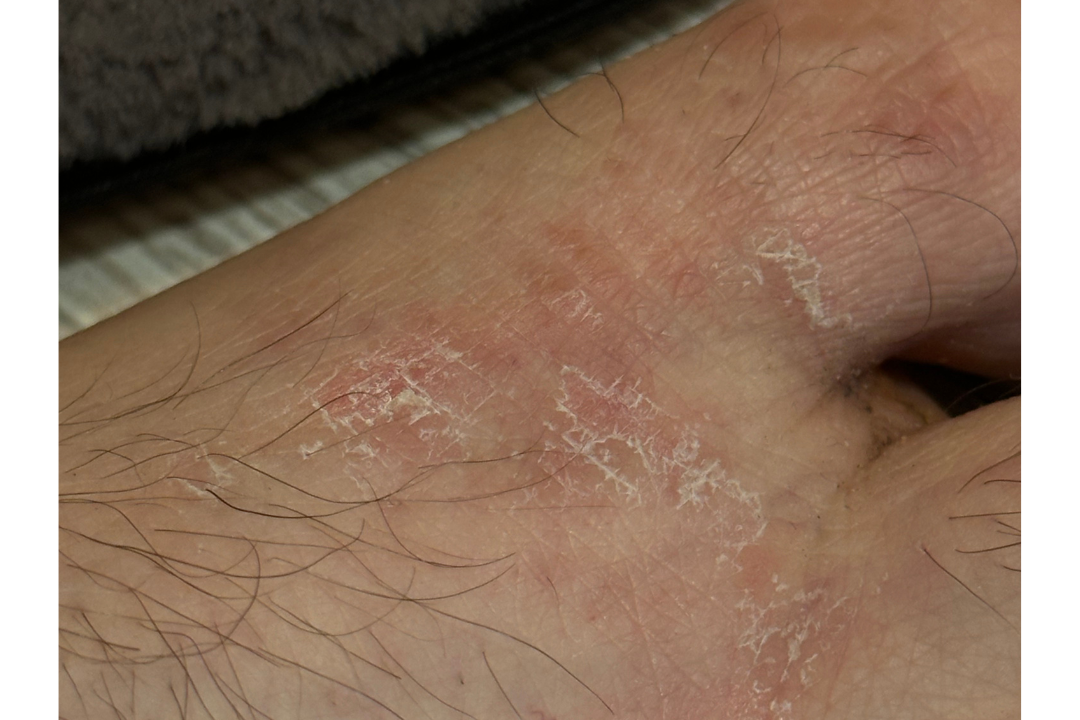 Экзема на ногах 