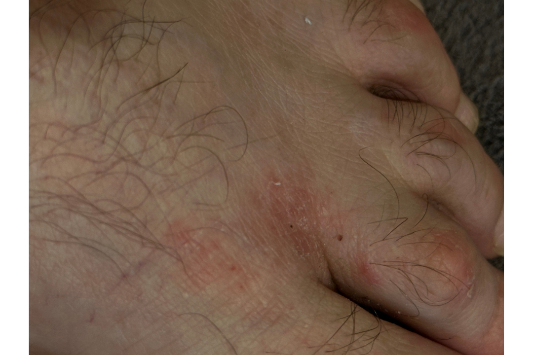 Экзема на ногах 