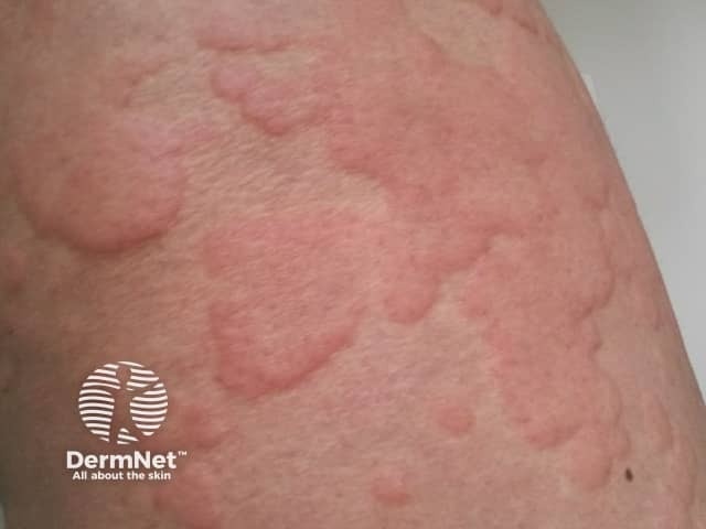 Фото из https://dermnetnz.org/topics/acute-urticaria