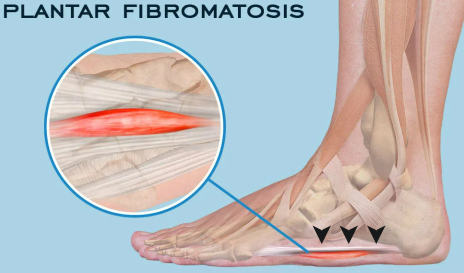 Черными стрелками показан ход подошвенного апоневроза (белый тяж), на котором виден узел, обозначенный красным цветом
