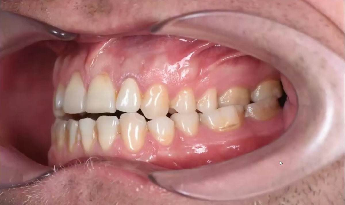 Неправильное смыкание зубов, выраженная стираемость