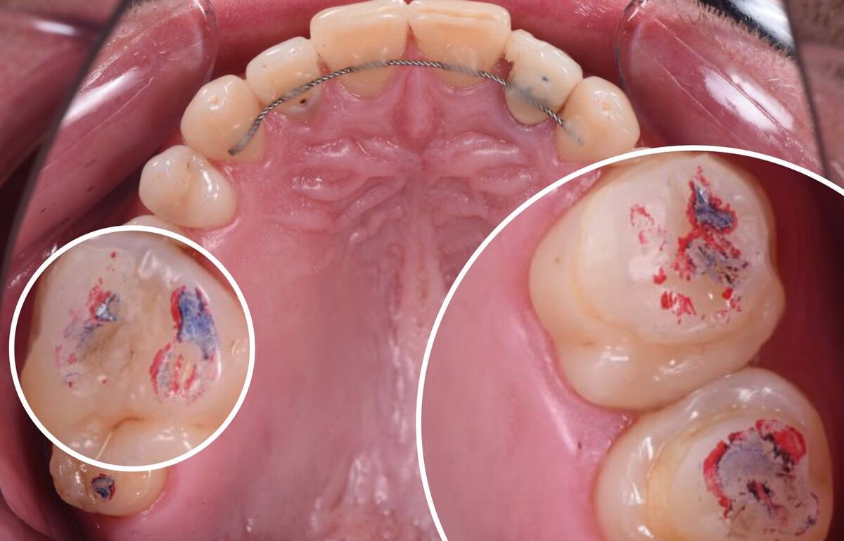 Композитные накладки на верхней челюсти