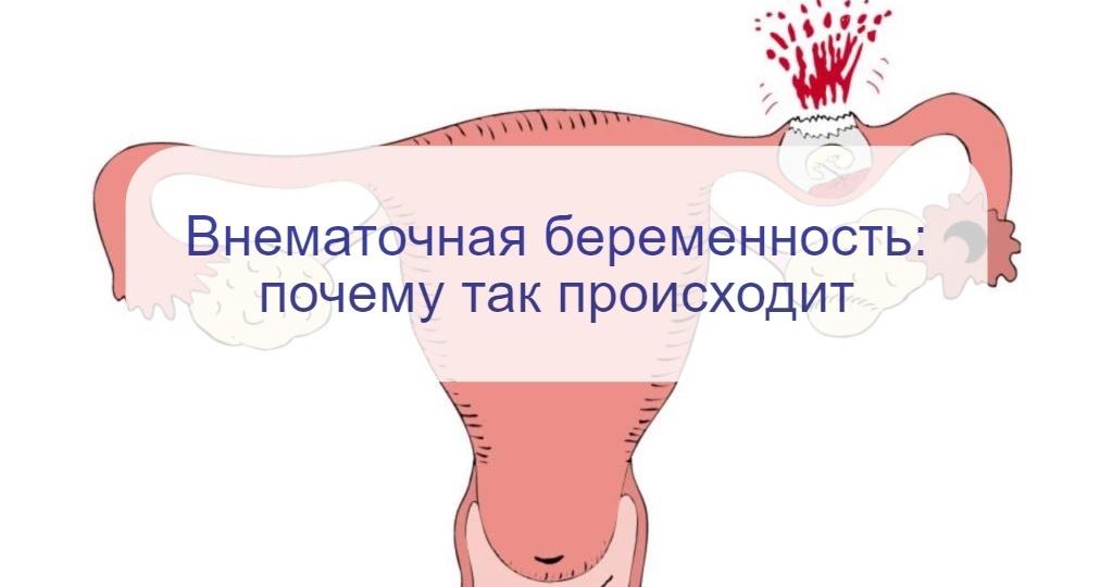 Чем опасна внематочная беременность и почему она не может завершиться благополучно?