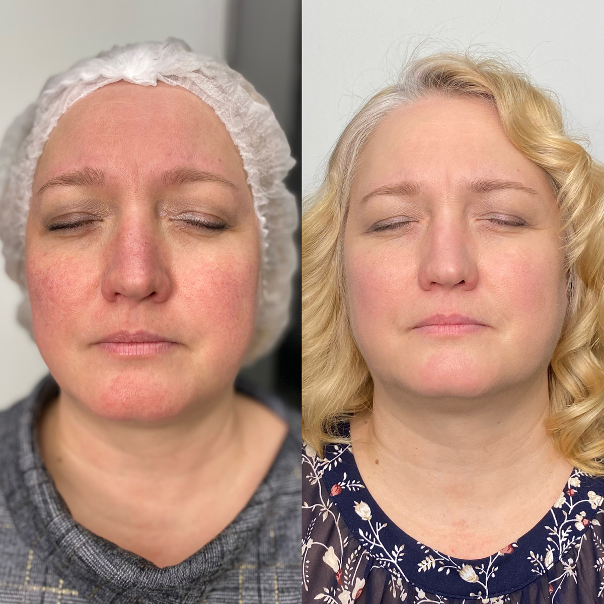 Удаление сосудов и пигментации в СПб UpGrade beauty