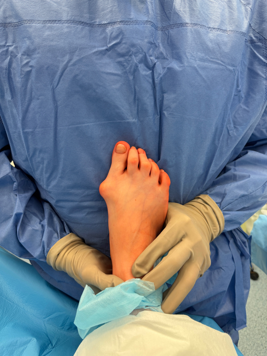 Перед операцией по хирургическому исправлению Hallux valgus