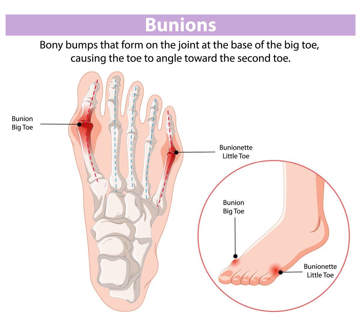 https://www.freepik.com/free-vector/understanding-bunions-their-effects_221767325.htm#fromView=search&page=1&position=33&uuid=8773be29-fdec-47c9-9a53-dd7ac16542cb&query=косточка+на+первом+пальце