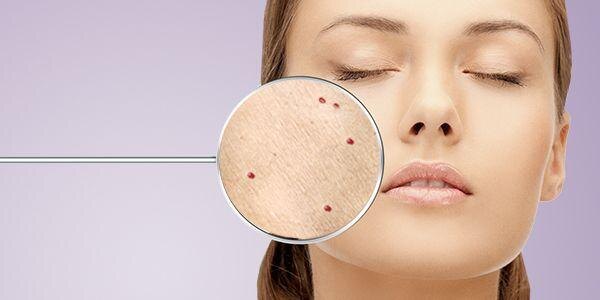 Почему на коже появляются красные родинки