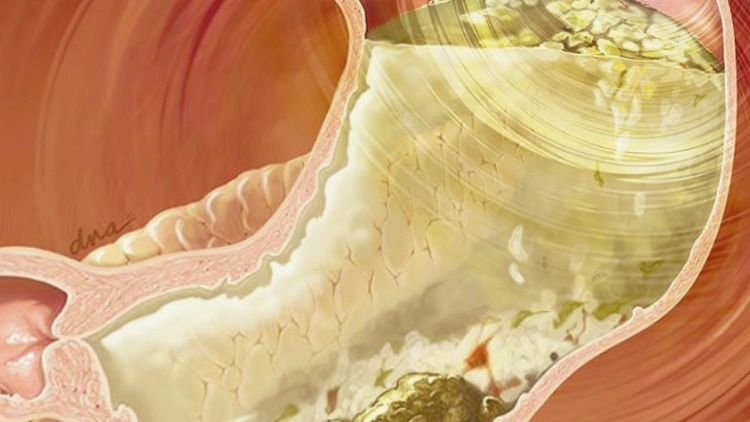 "Бродящие" остатки пищи на стенках ЖКТ (фото из открытых источников)