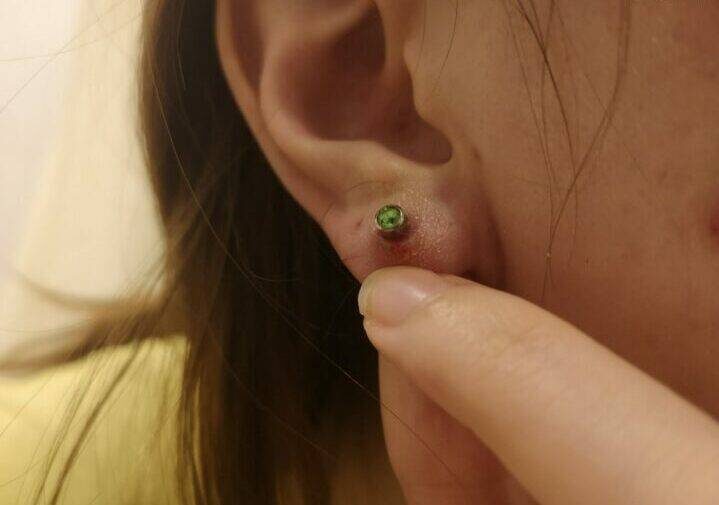 после ношения бижутерии с плохим металлом