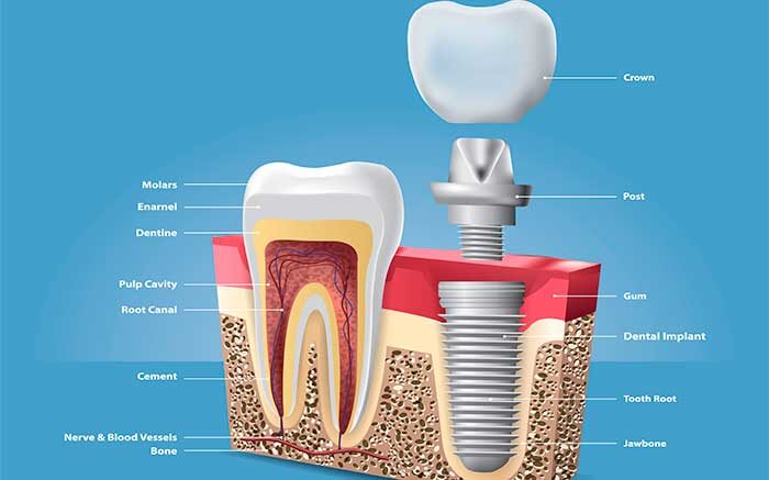 Что вы можете сделать, чтобы заменить отсутствующие или разрушенные зубы?