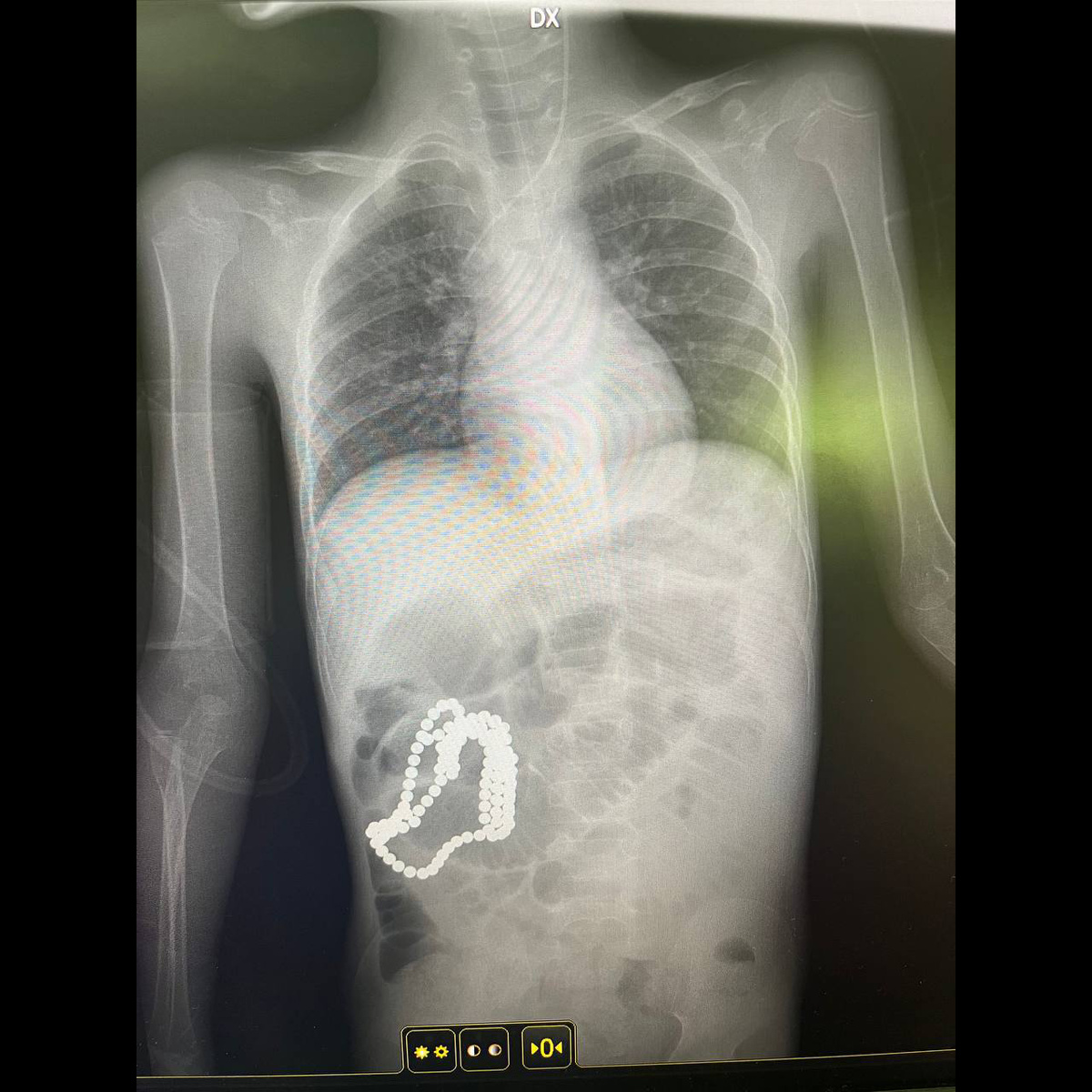    Опасная игрушка: как маленькие магнитные шарики приводят к большим проблемам