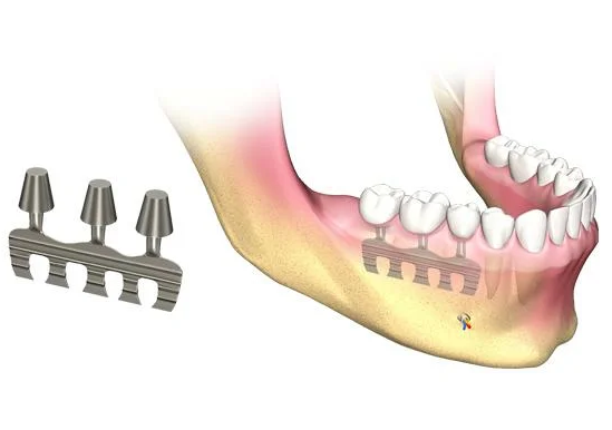 Пластиночный имплантат для трех коронок