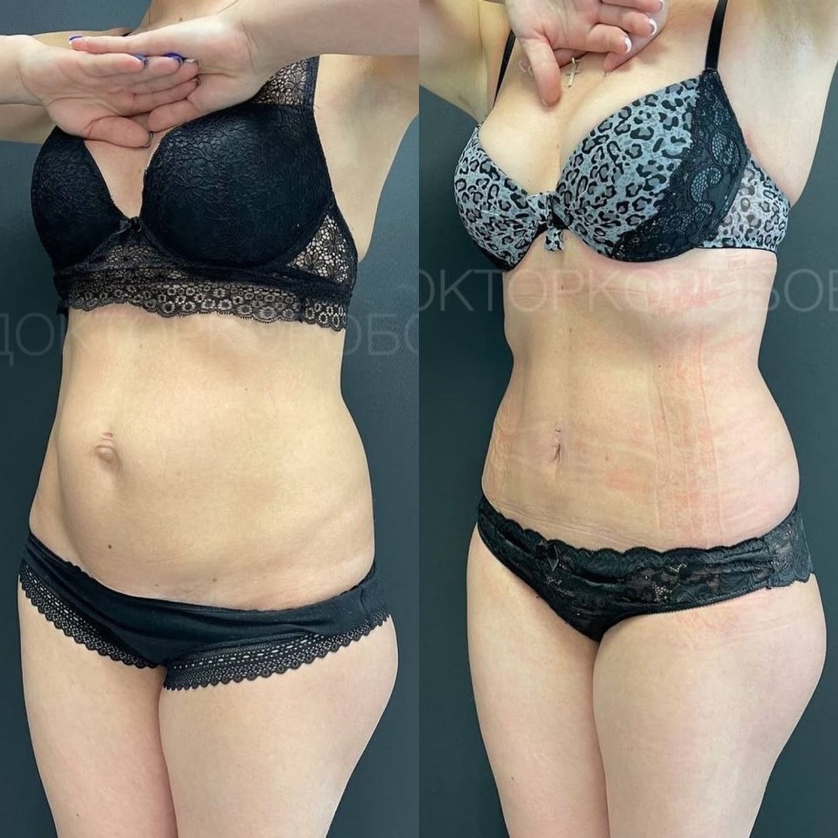 Миниабдоминопластика с ушиванием диастаза и пупочной грыжи + липосакция. 2 месяца после операции.