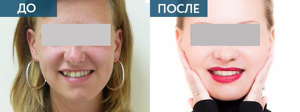 Исправление прикуса хирургическим путем. ДО и ПОСЛЕ.