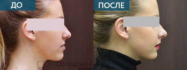 Исправление прикуса хирургическим путем у врослого пациента. ДО и ПОСЛЕ.