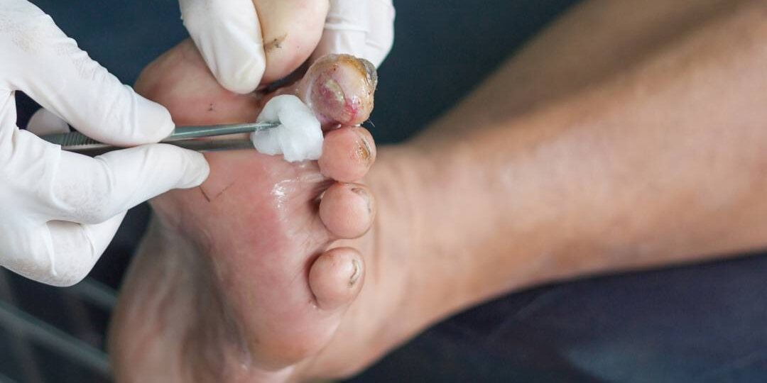 Диабетическая стопа: как предотвратить язвы и сохранить здоровье ног