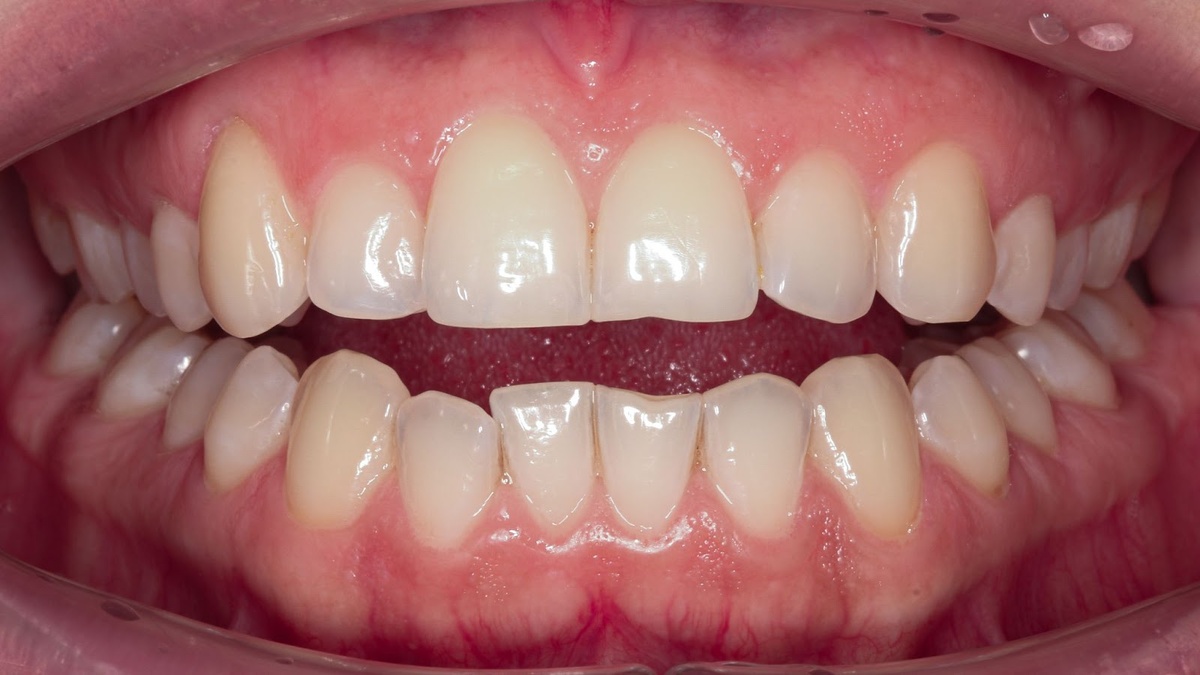 Зубы Елены ДО лечения