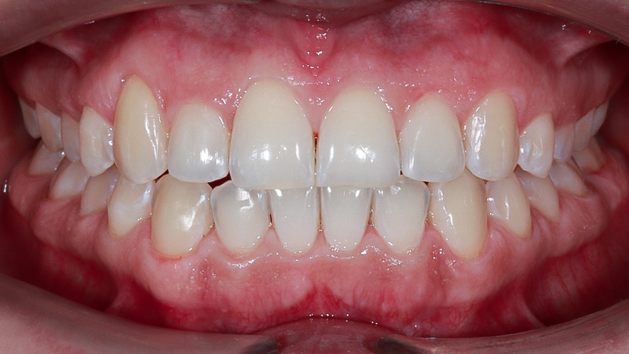 Зубы Елены ПОСЛЕ лечения