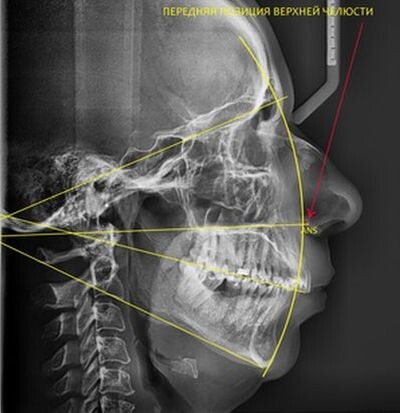 Передняя позиция (антепозиция) верхней челюсти.