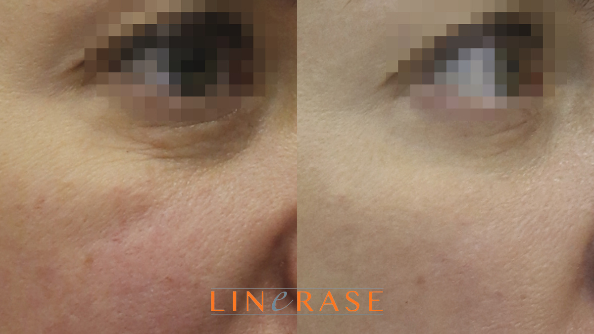 Фотографии до-после (листайте галерею)