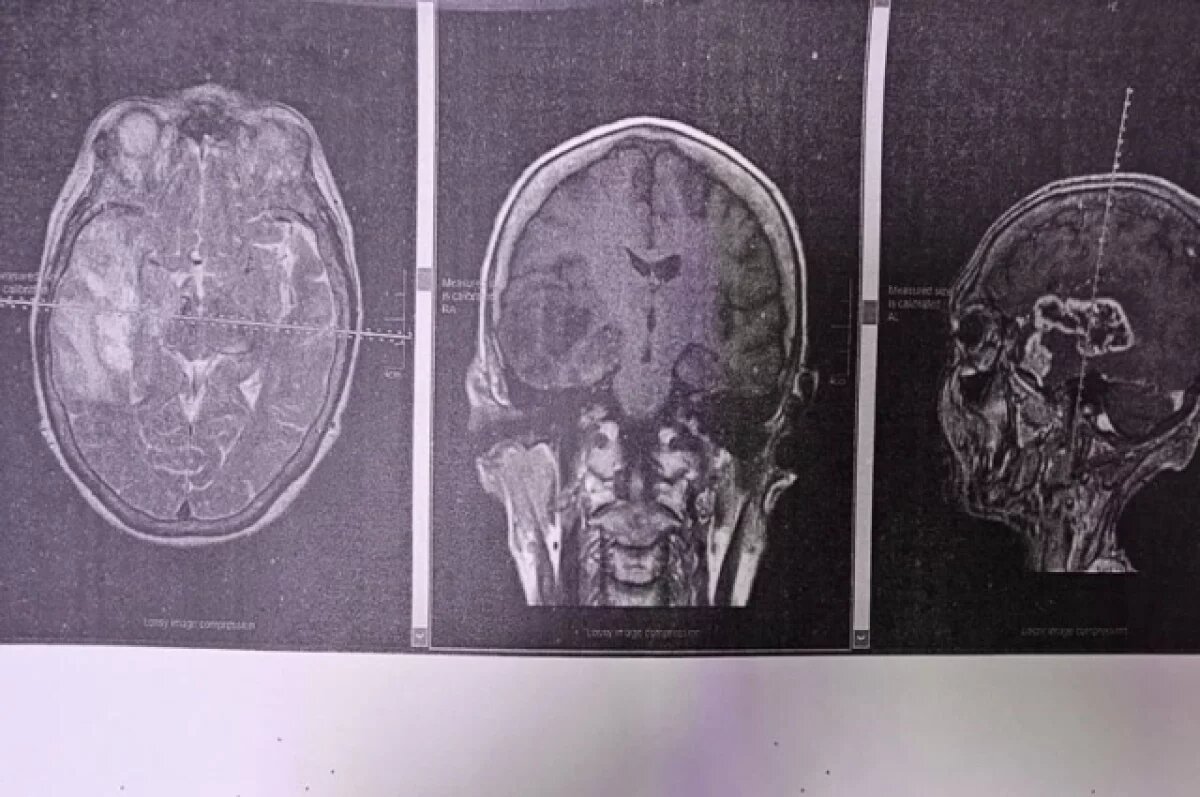    У красноярца из-за постоянных головных болей онемело лицо
