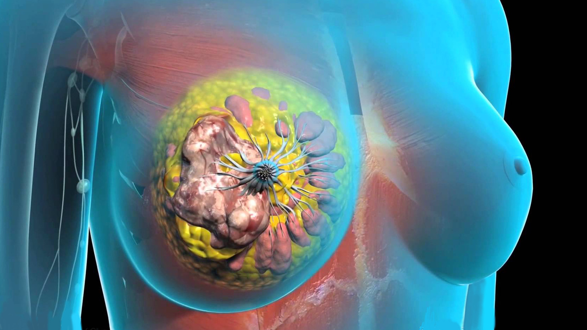 Рак груди, который скрывается между маммографиями