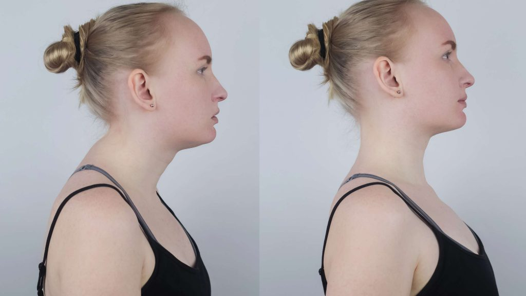 Вдовий горб: шейная холка у женщин