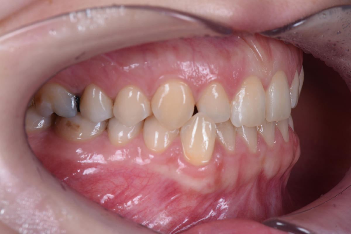 Нижние резцы у Марии сильно задавлены верхними