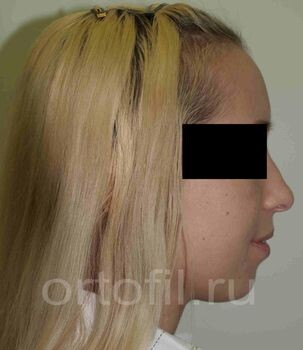 Пример "выпуклого" профиля лица.
