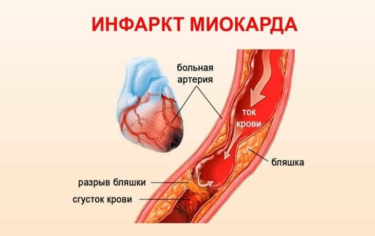 Стрессовый инфаркт. Инфаркт мил. Инфаркт миокарда картинки. Инфаркт миокарда.инфаркт миокарда..