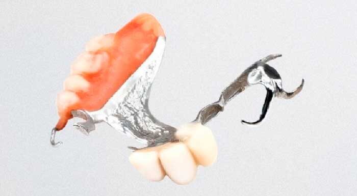 Частичные зубные протезы