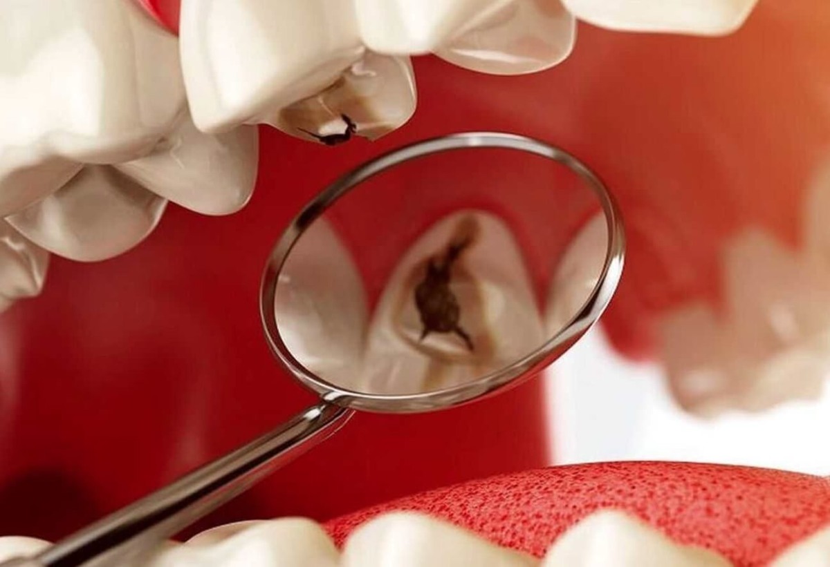    Иногда кариес не виден, и его может обнаружить только стоматолог. Источник изображения: prstom.com